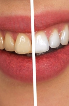 Teeth Whitening